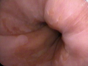 Short Segment Barrett's esophagus. The stomack lining (that is salmon-color) has grown up into the esophagus. This is caused by acid reflux disease.