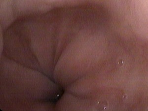 This is the appearance of the distal esophagus, specifically the area of the gastro-esophageal (GE) junction